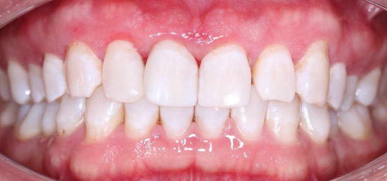 After image
