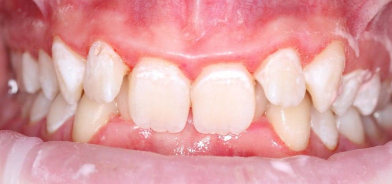 After image