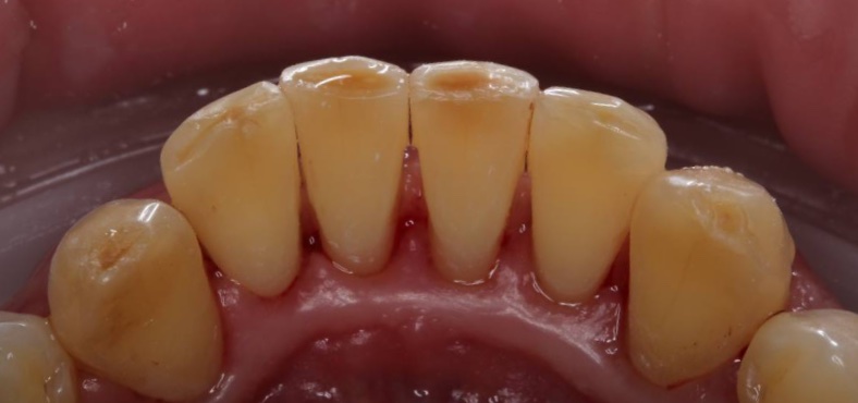 After image
