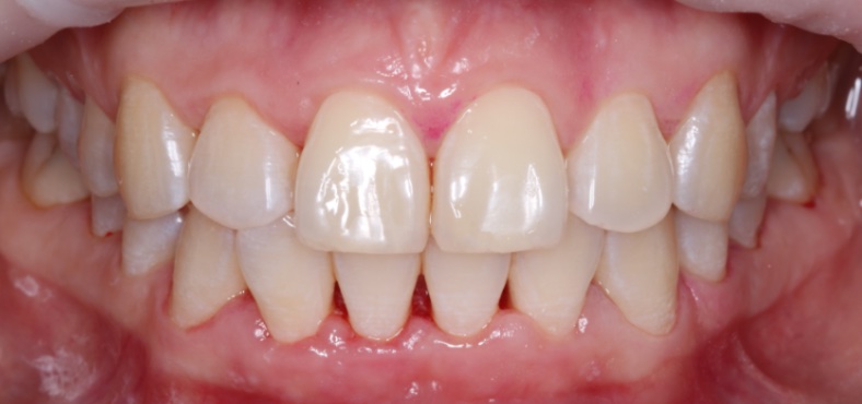After image