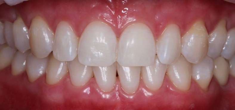 After image
